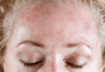 New Research Reports That Certain Foods Can Be The Source Of Skin Issues