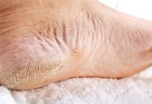 Top Doctor: New Discovery Makes Foot Calluses “Vanish”