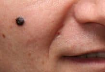 Gut Bacteria Could Make Skin Cancer Drugs More Effective