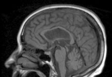 Dementia Rate Drops 24 Percent in the US