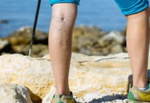 Getting Rid Of Spider Veins Without Surgery?