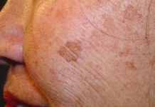 Beverly Hills Doctor’s At-Home Dark Spot Solution