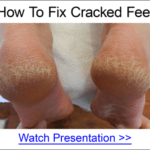 foot-callus