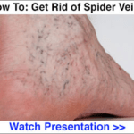spider-vein-ads
