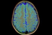 MRI Scans Show the Brain Can ‘Rust’