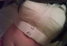 Breast Reduction Surgeries on the Rise: Report