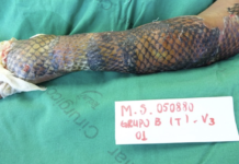 Doctors Use Fish Skin to Treat Woman’s Burn Injuries