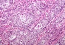 Cervical Cancer Death Rates Are Higher Than Everyone Thought