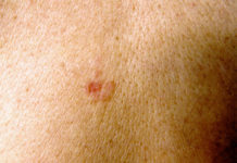 ‘Automated Dermatologist’ May Detect Skin Cancer With Same Accuracy as Real Doctors