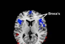 Stuttering Linked to Low Blood Flow in Brain