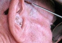 What’s That? Lack Of Iron May Be Associated With Hearing Loss