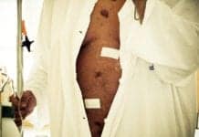 Weight Loss Surgery Linked to Lasting Gut Problems