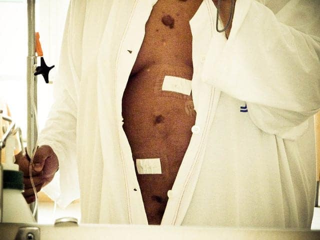 Picture of Weight Loss Surgery Linked to Lasting Gut Problems