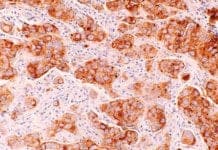 Far Fewer People Are Dying From Cancer — Here’s Why