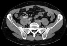 Your Appendix May Not Be Useless After All