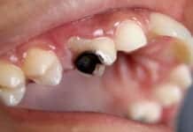 Common Alzheimer’s Drug May Cure Tooth Decay