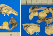 Doctors Discover Brain Inside Teen’s Ovary