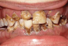‘Mountain Dew Mouth’ May Rot Your Teeth Like Doing Meth
