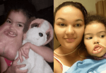 Toddler Receives Life-Saving Surgery to Remove Rare 5-Pound Facial Tumor