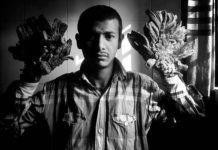 ‘Tree Man’ Has Surgery to Remove Branch-Like Hands