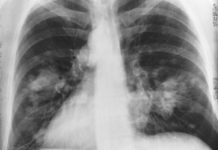 Where You Live May Determine Your Risk of Dying From Certain Cancers