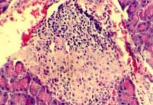 Fasting Diet Reprograms Pancreatic Cells, Reverses Diabetes in Mice