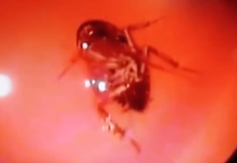 Doctors Remove Large Cockroach Lodged Inside Woman’s Skull