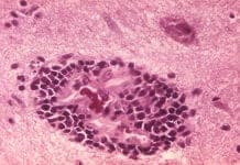 Scientists Mimic Deadly Rabies Virus to Destroy Brain Cancer Cells