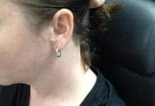 Innovative Behind-the-Ear Technique Avoids Neck Scarring After Thyroid Surgery