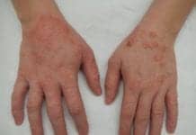 Probiotic Cream Made From Body’s Own Bacteria May Cure Eczema