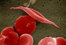 Gene-Therapy Used to Cure Boy of Sickle Cell Disease