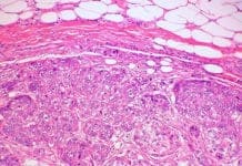 Breast Cancer Grows More Rapidly in Obese Patients: Study