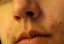 Balancing Bacteria May Be Key to Preventing Breakouts