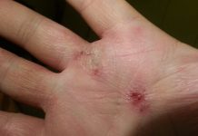 Bacterial Spray Could Help Clear Up Eczema