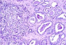 Scientists Reveal New Prostate Cancer Vaccine