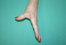 Arthritis Vaccine Could Emerge From Stem Cell Technology