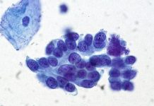 Cervical Cancer Screening Should Continue Past Age 65