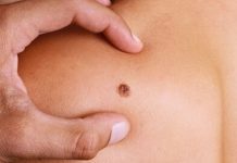 5 Ways to Check Your Body for Skin Cancer