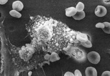 Scientists Disable Cancer’s Ability to Spread Using Tiny Gold Rods