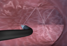 No Cuts About It: Non-Surgical Weight Loss Procedure Shows Results