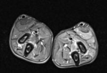 Muscular Dystrophy Reversed in Dogs