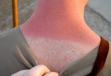 Vitamin D May Ease Sunburns by Reducing Skin Damage