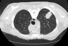 Do CT Scans Encourage Smokers to Quit?